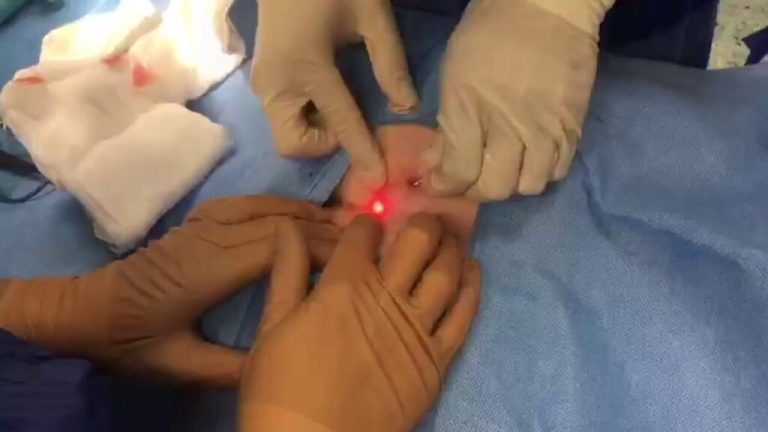 Expert doctors at the best pilonidal cyst laser center in Tehran